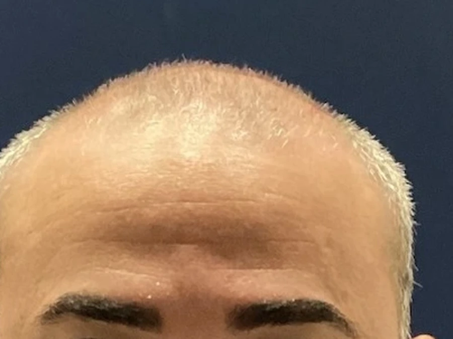 Antes do transplante capilar