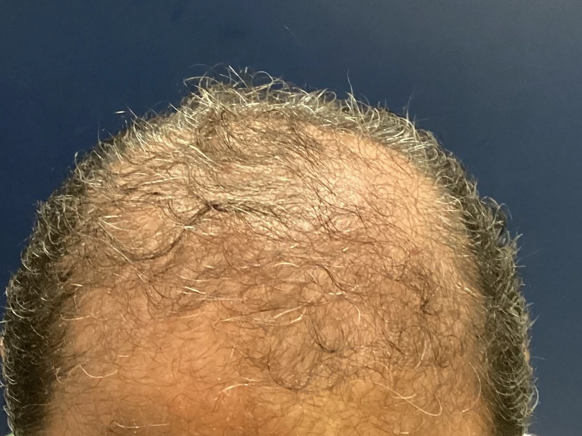 Antes do transplante capilar