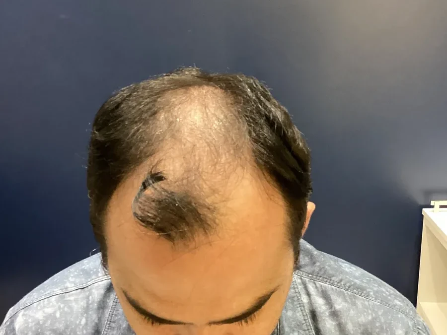Antes do transplante capilar, caso 3