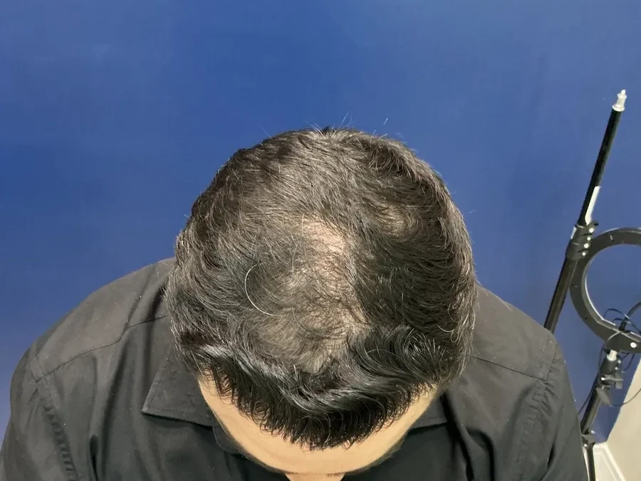 Resultado após o transplante capilar, caso 3