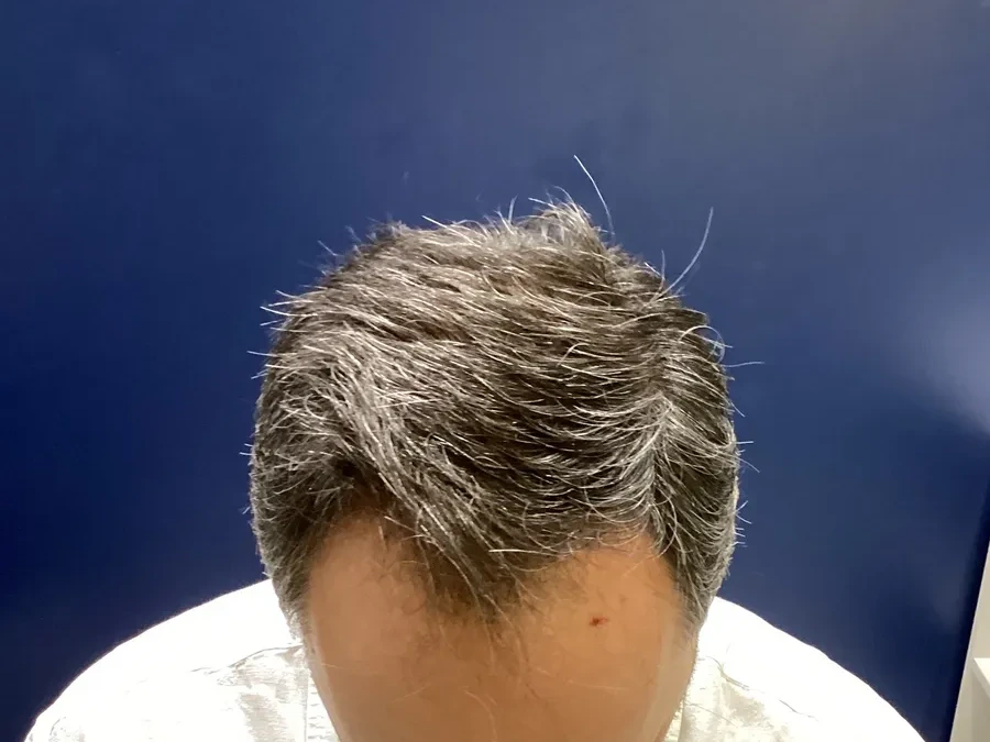 Antes do transplante capilar, caso 4