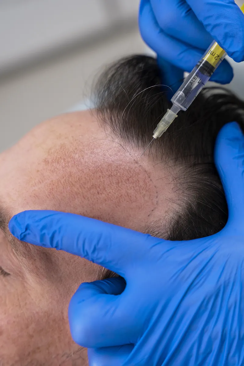 Técnica FUE No-Shave, transplante capilar sem raspar